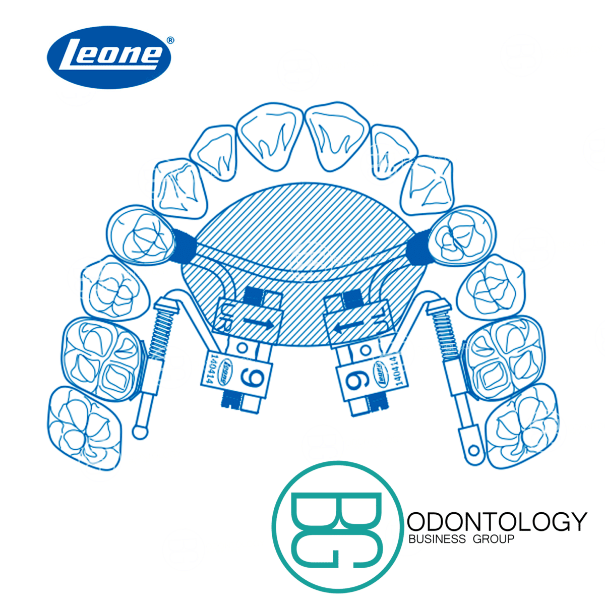 Distalizador Fast Back -Marca: Leone Tornillos | Odontology BG